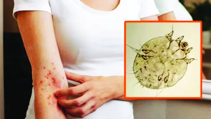 მუნის შემოტევა: ყველაფერი, რაც ამ დაავადებაზე უნდა ვიცოდეთ - "ეს არ არის უბრალოდ „ქავილი,  ეს არის ს...